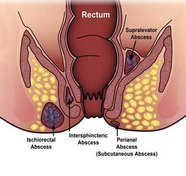 abscess treatment best abscess treatment in pune