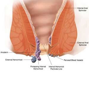 Piles Surgeon near me