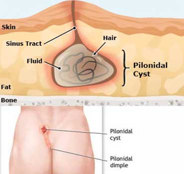 pilonidal sinus pilonidal sinus surgery recovery time