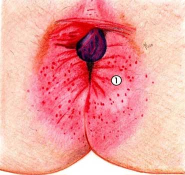 pruritus ani treatment