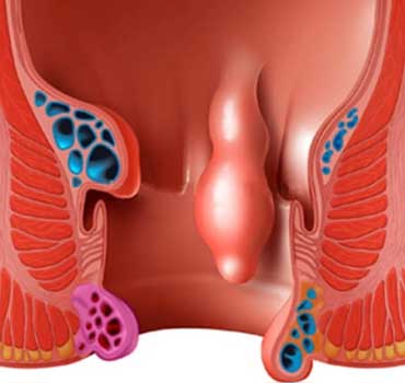 rectal polyps treatment